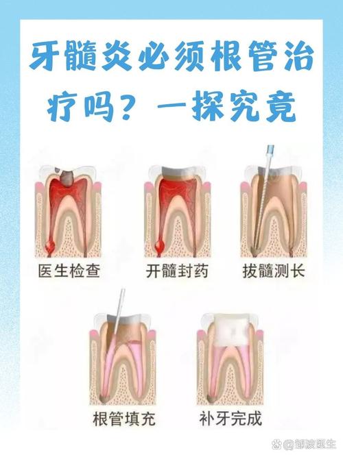 什么情况要根管治疗