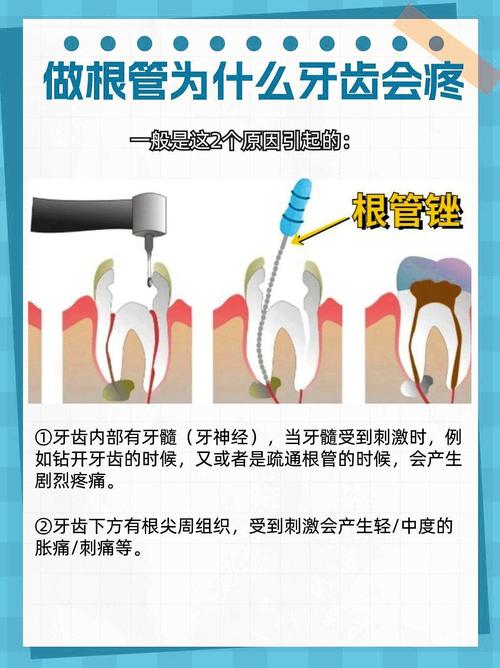 什么情况要根管治疗