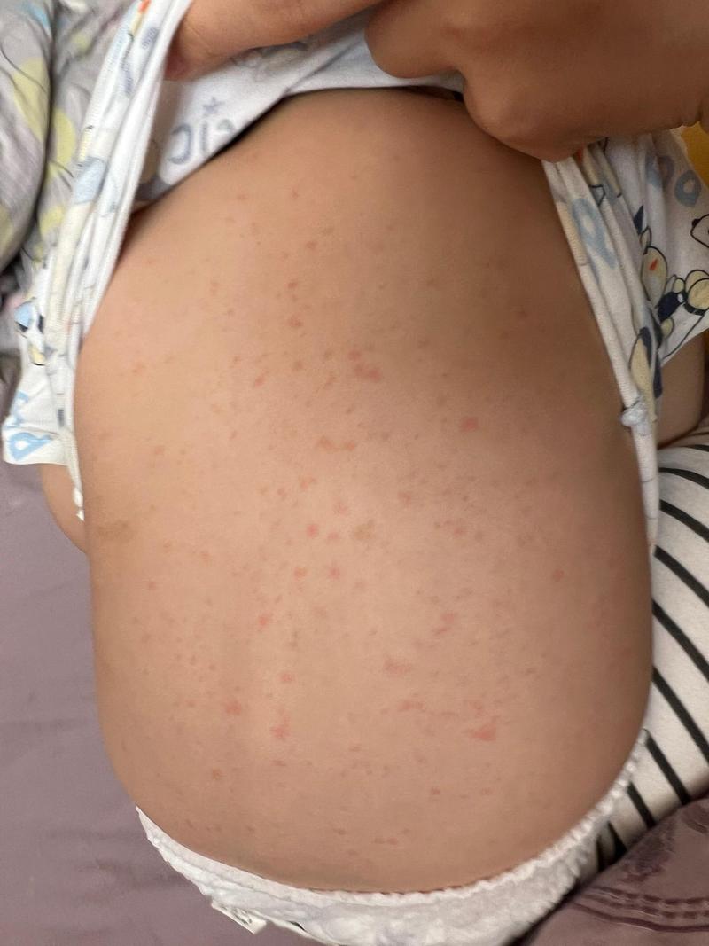 疹子是什么样的图片