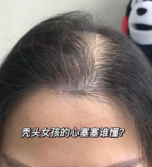女生为什么会脱发
