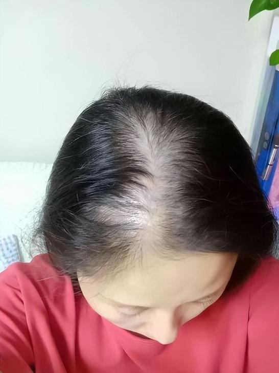减肥后为什么会掉头发