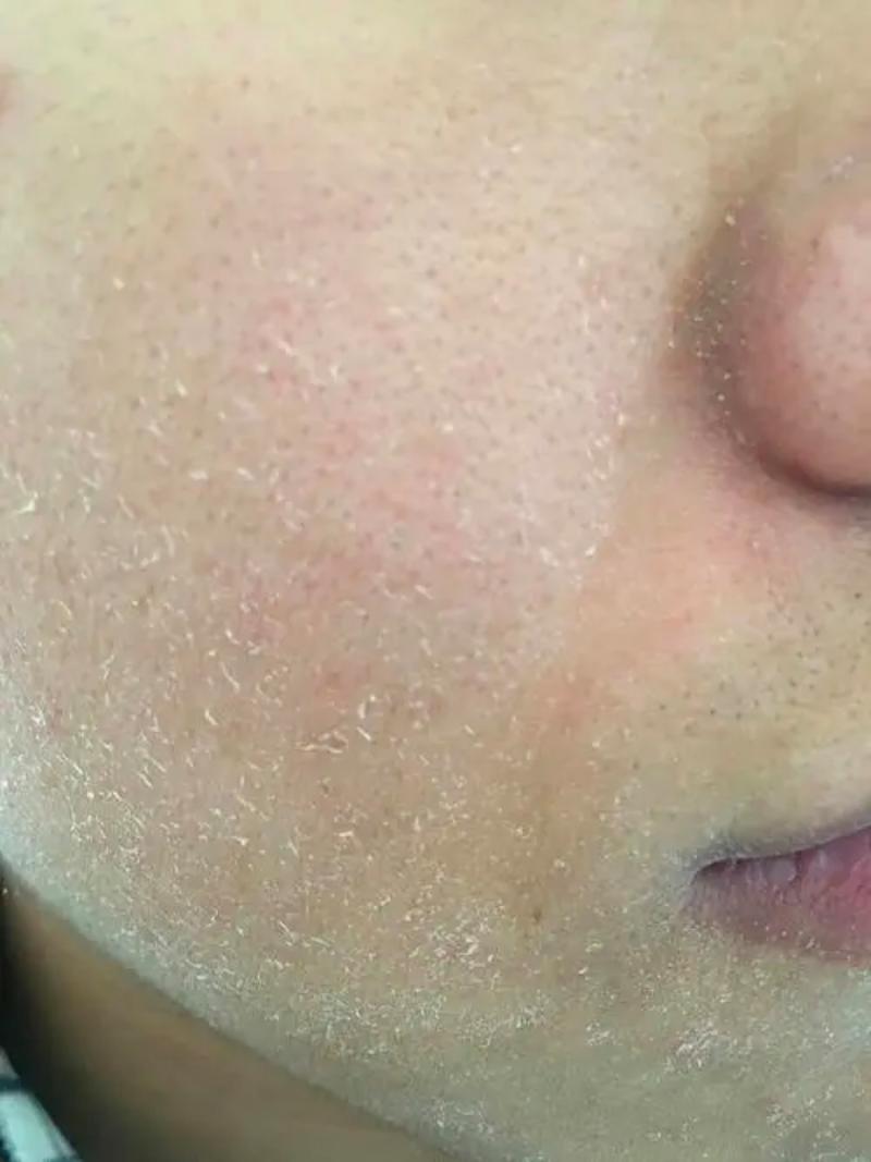 脸上脱皮是什么情况