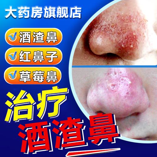 红鼻子用什么药膏