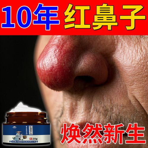 红鼻子用什么药膏