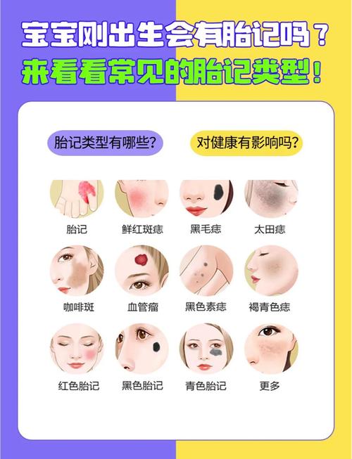为什么婴儿会有胎记