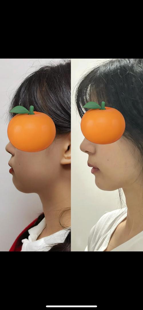 龅牙为什么