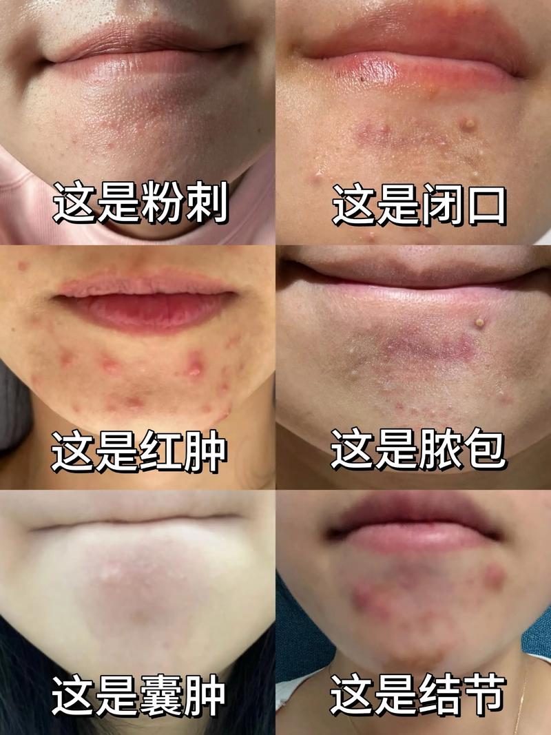 下巴长粉刺是什么原因