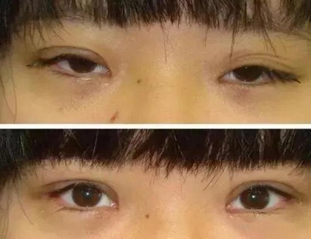 什么是三眼皮