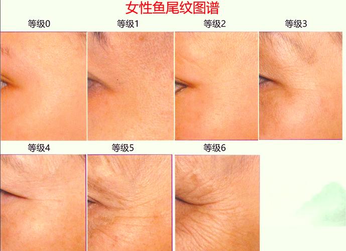 鱼尾纹长什么样