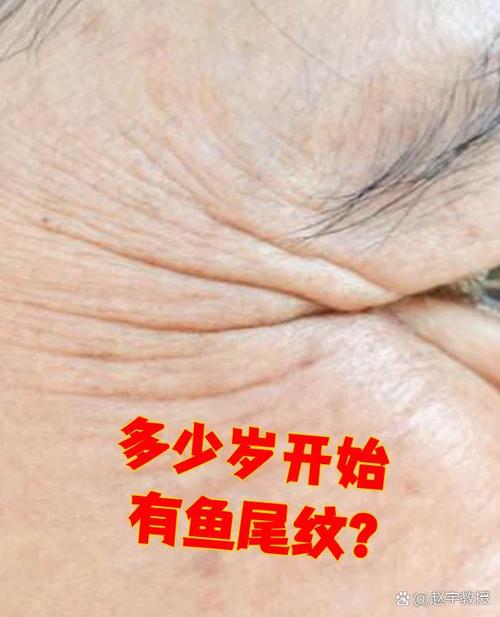 鱼尾纹长什么样