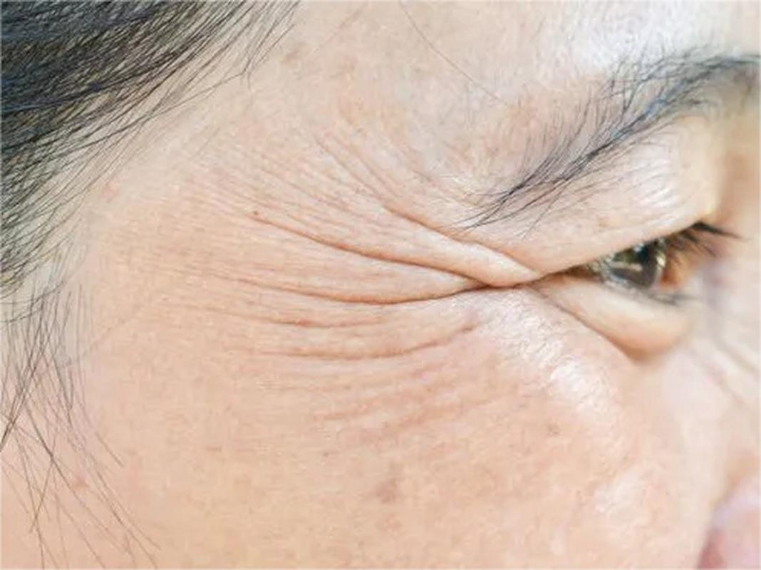 鱼尾纹长什么样