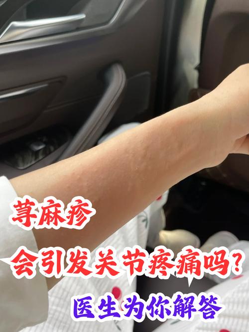 荨麻疹又叫什么