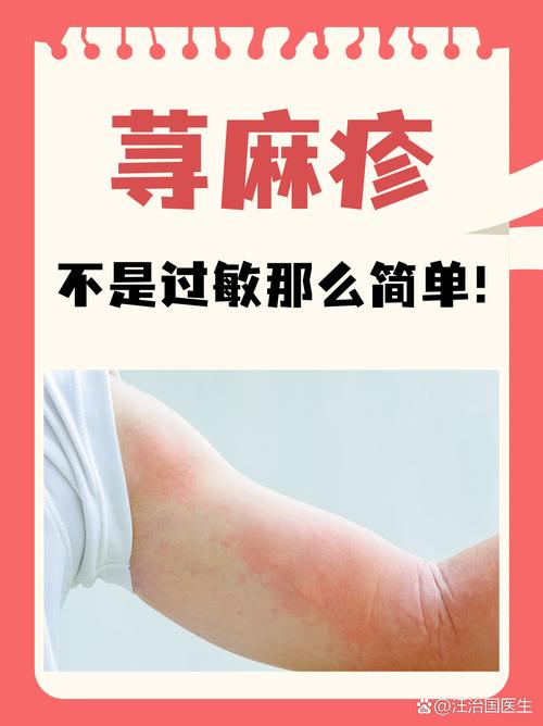 荨麻疹又叫什么