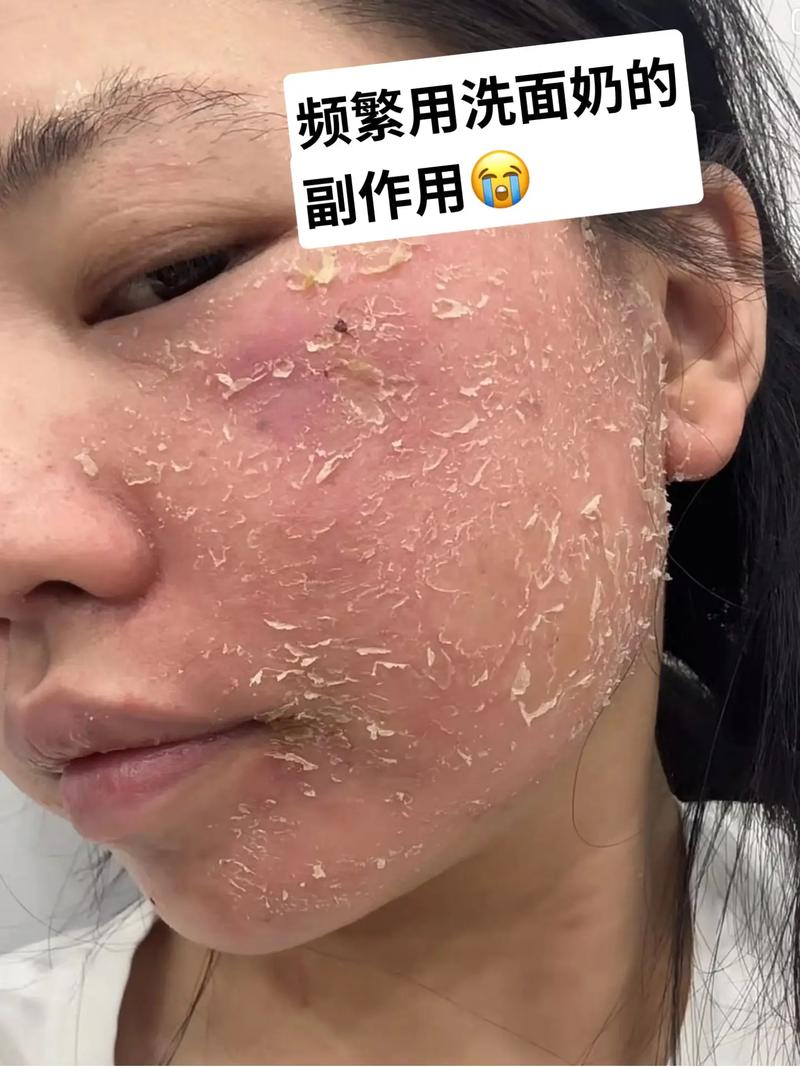 洗面奶用多了会怎么样