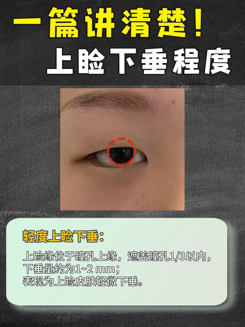 眼睑下垂看什么科