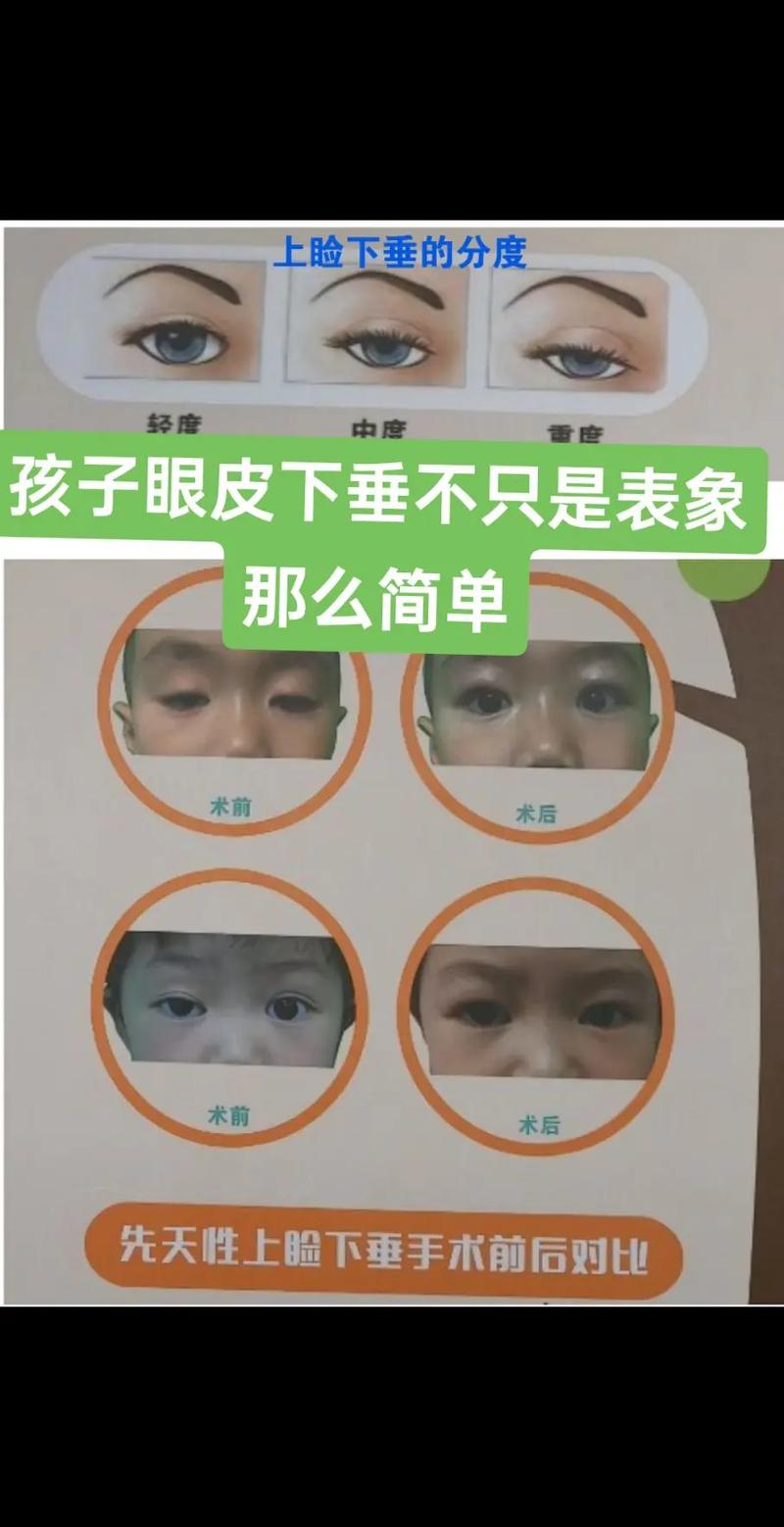 眼睑下垂看什么科