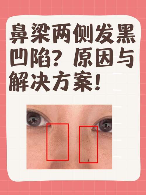 为什么会有黑鼻头