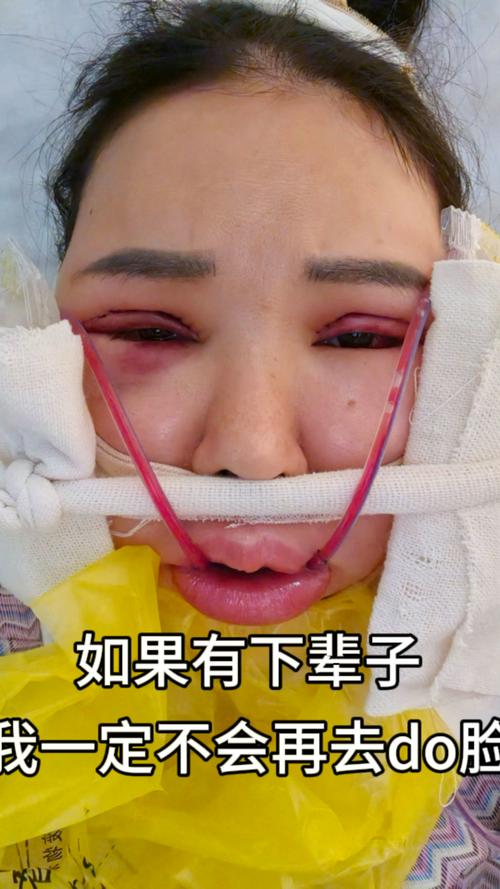 为什么整容没有疤痕