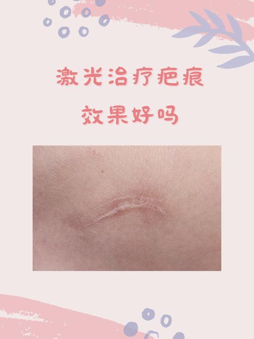 什么激光最好