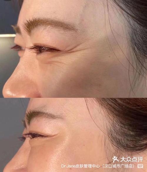 什么去鱼尾纹好