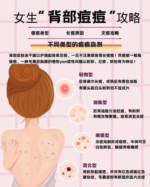 身上长粉刺什么原因