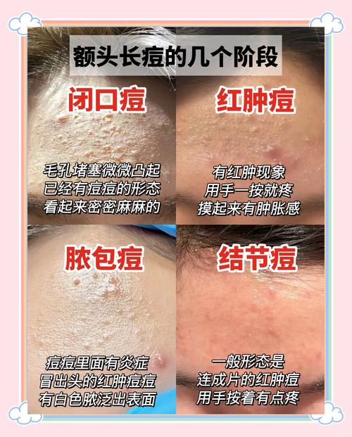 额头长痘痘是为什么