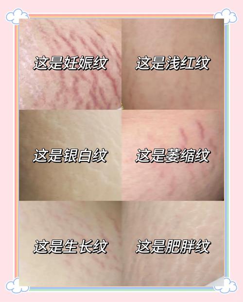 妊娠纹有什么危害
