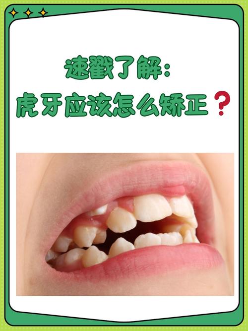 人为什么有虎牙