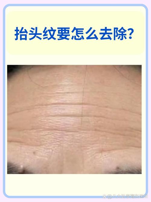 什么叫抬头纹