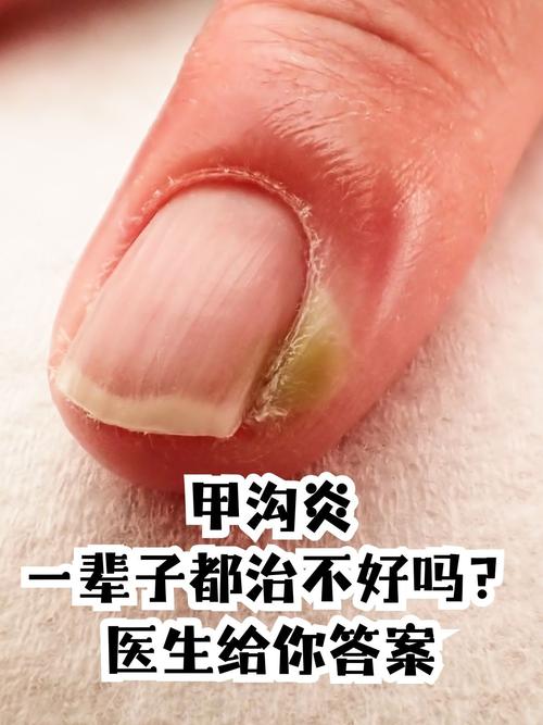 什么原因引起甲沟炎