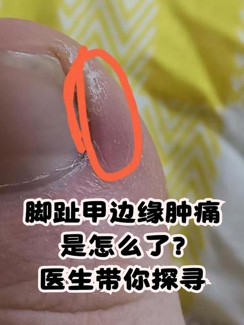 什么原因引起甲沟炎