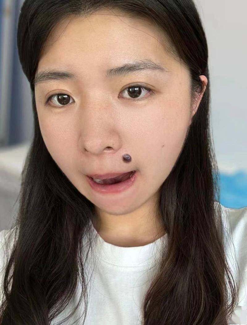 脸上为什么老长痣