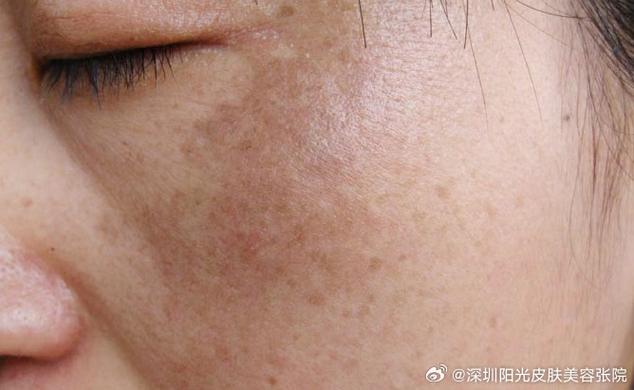 色素沉着是什么颜色