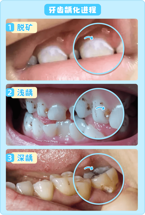什么是牙齿钙化