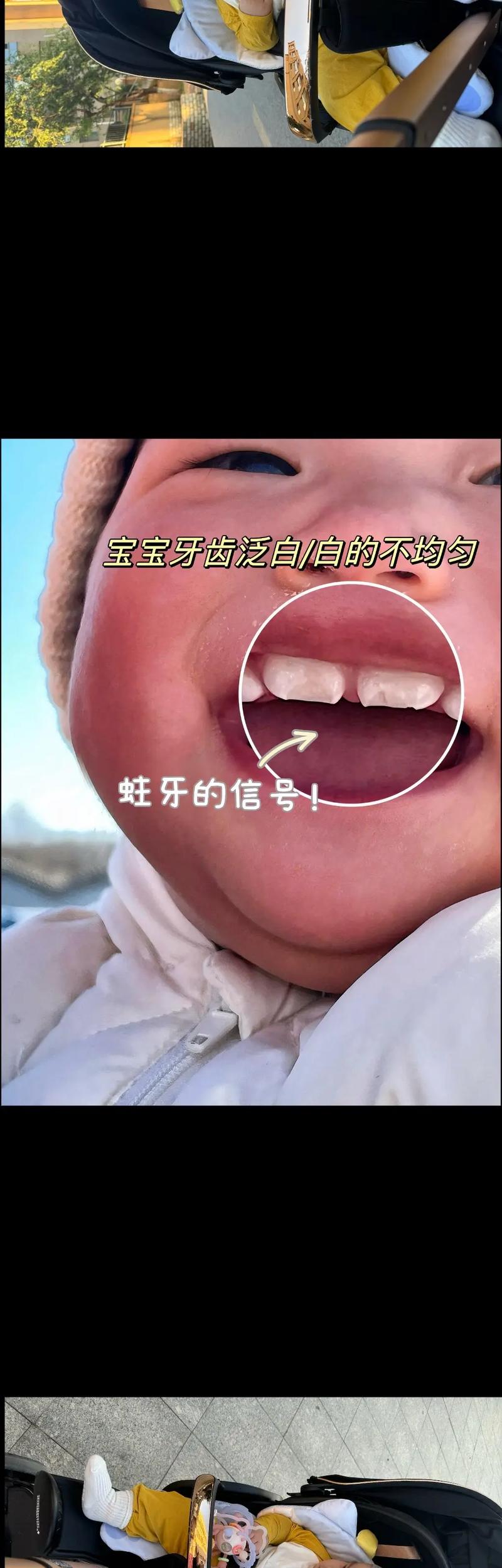 什么是牙齿钙化