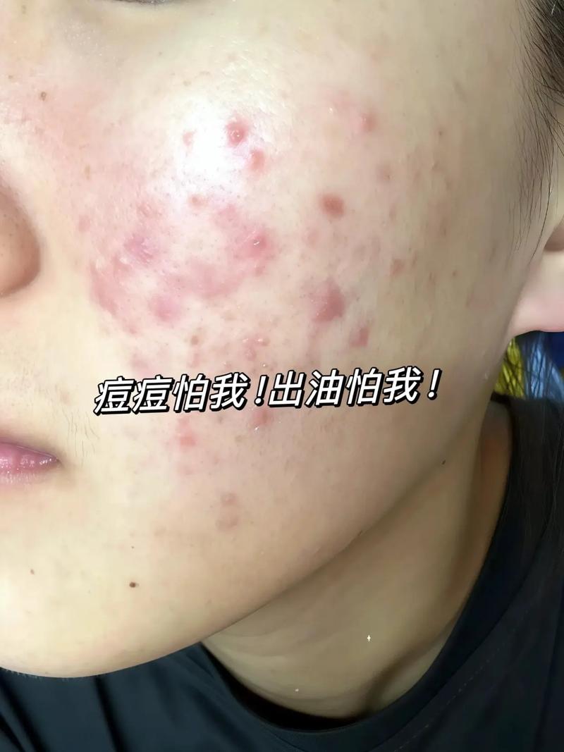 洗面奶洗出痘痘怎么办