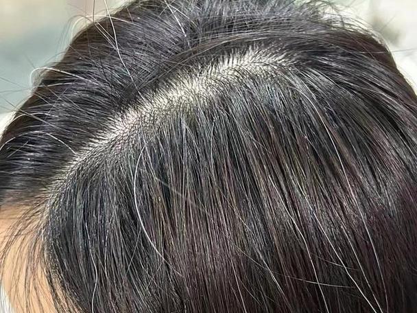 年轻为什么有白头发