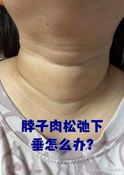 脖子太粗了用什么减肥