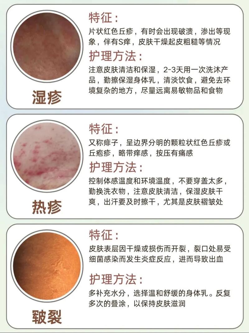 宝宝长湿疹什么原因