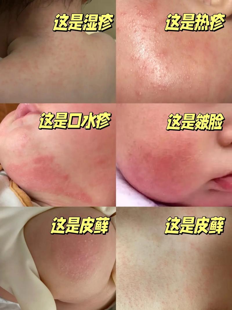 宝宝长湿疹什么原因