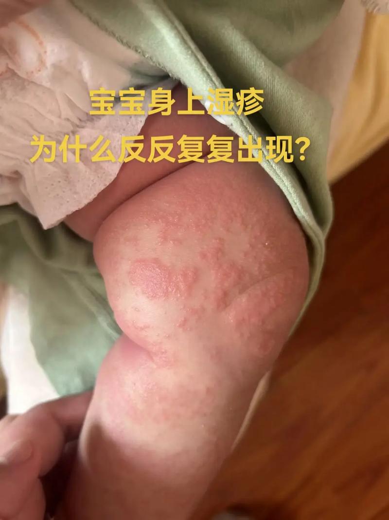 宝宝长湿疹什么原因