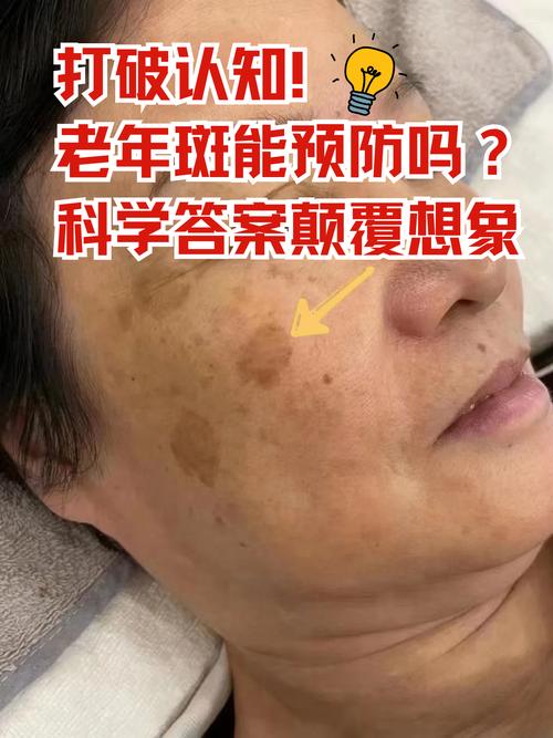 为什么会有老人斑