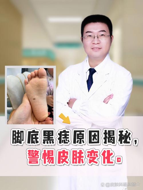 左脚底长痣代表什么