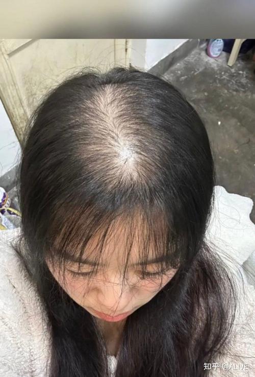 女性掉头发缺什么