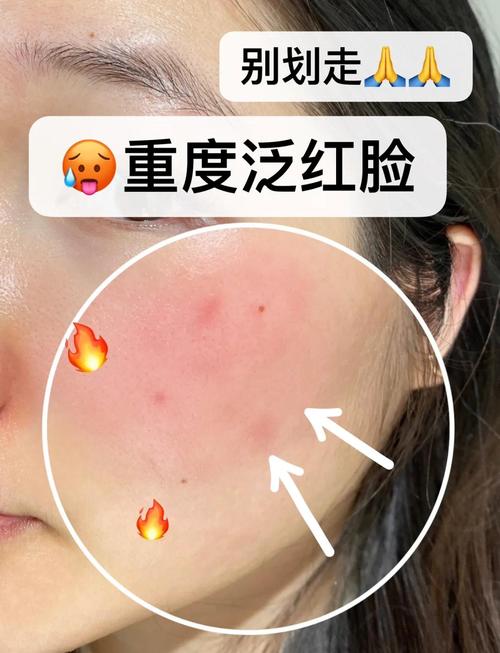 面部泛红是什么原因