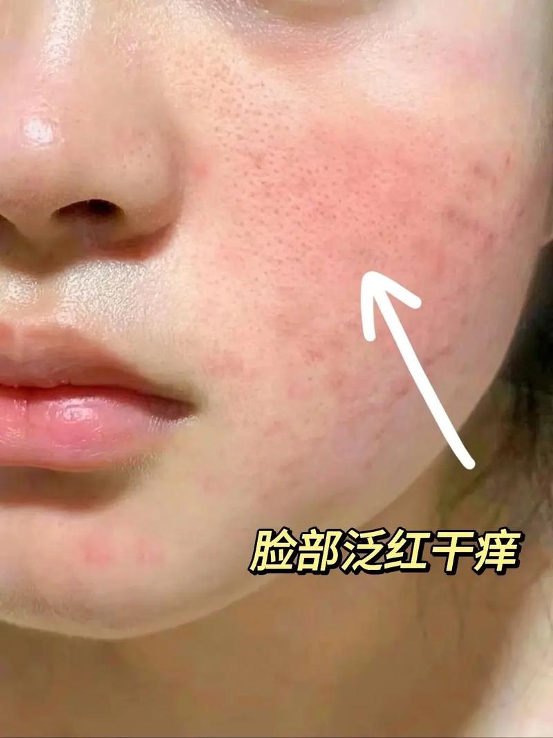 面部泛红是什么原因
