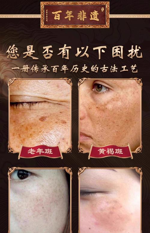 中药什么去斑