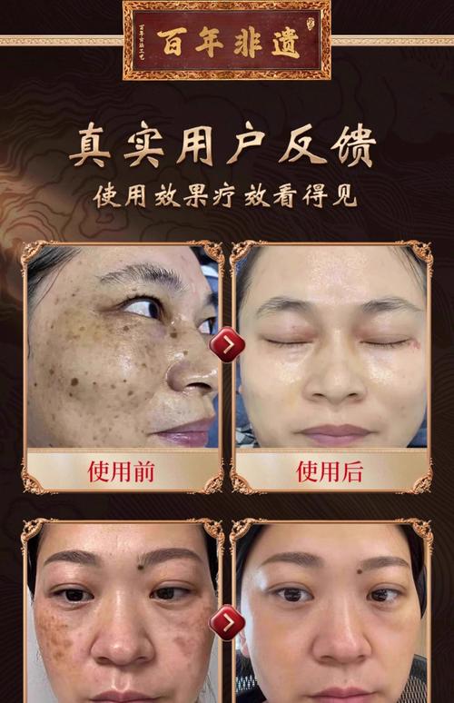 中药什么去斑