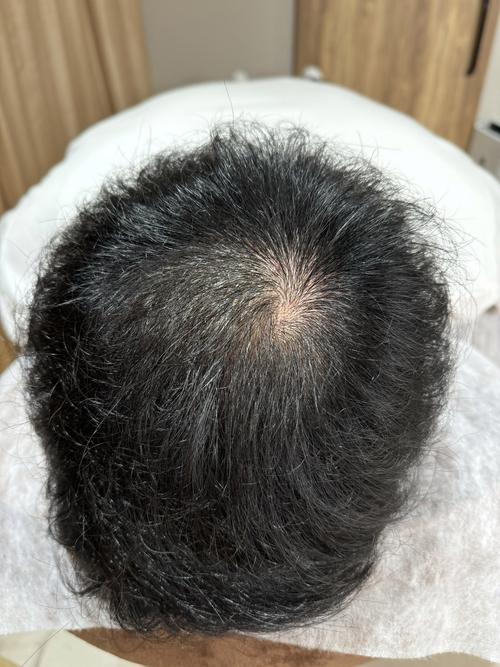 脂溢性脱发什么症状