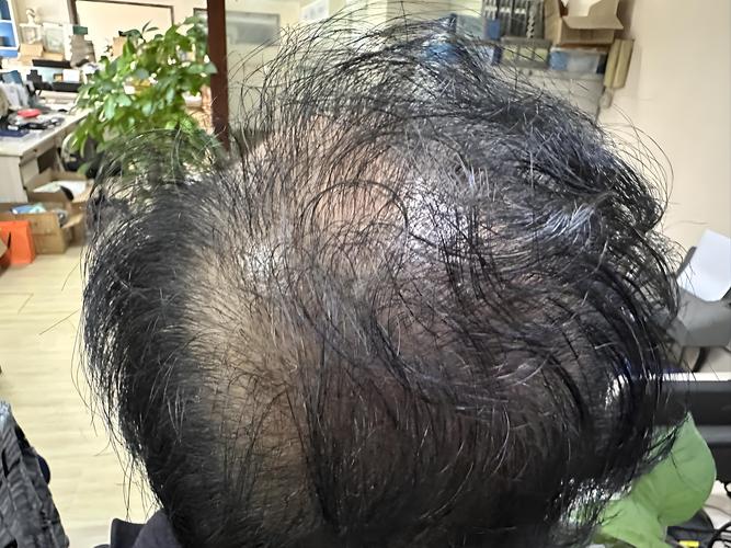 脂溢性脱发什么症状